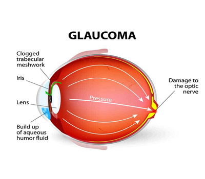 Glaucoma