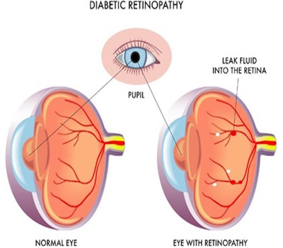 Retina & Diabitic Retinopathy